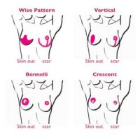 An illustration showing a breast scar comparison for various techniques.