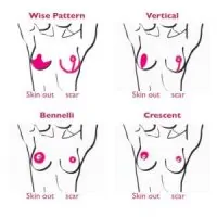 An illustration showing a breast scar comparison for various techniques.