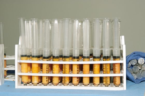 A rack of syringes containing extracted fat.