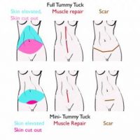 An illustration showing Tummy Tuck vs. Mini Tummy Tuck Abdominoplasty Surgery.