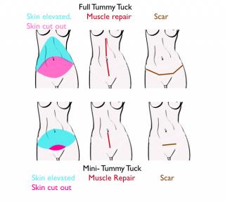 An illustration showing Tummy Tuck vs. Mini Tummy Tuck Abdominoplasty Surgery.