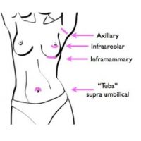 An illustration showing incision types for breast augmentation: inframammary, infraareolar, TUBA