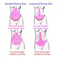 An illustration showing the different Tummy Tuck techniques.