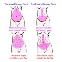 An illustration showing the different Tummy Tuck techniques.