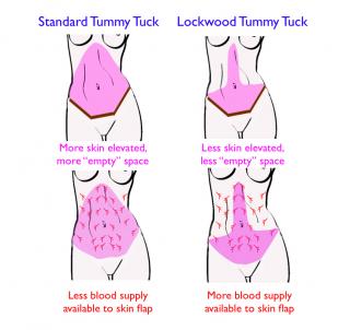 An illustration showing the different Tummy Tuck techniques.