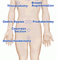 An illustration showing common areas where the pain pump offers pain relief (from the OnQ web site)