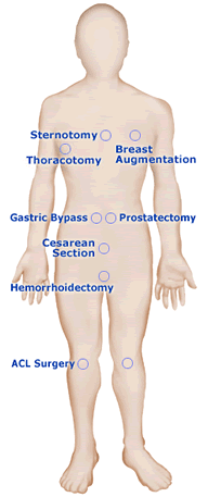 An illustration showing common areas where the pain pump offers pain relief (from the OnQ web site)