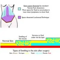 An illustration showing postoperative swelling stages.