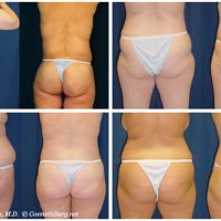 Before and after photos from patients who have had a body lift