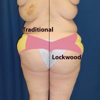 A photo of a patient's body, showing her body before and after a body lift procedure.