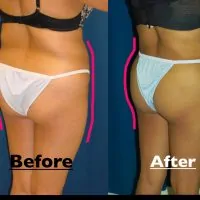 A composition photo of a patient's buttocks, showing the patient before and after a B'more butt lift.