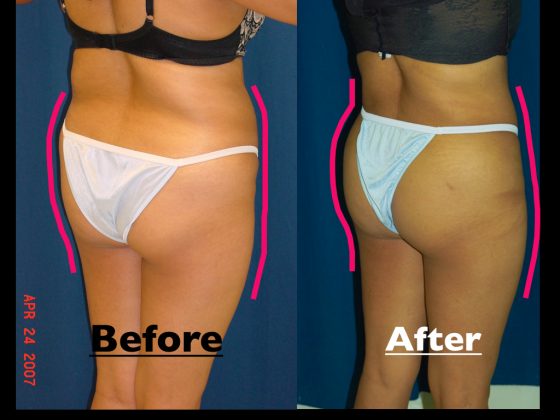 A composition photo of a patient's buttocks, showing the patient before and after a B'more butt lift.