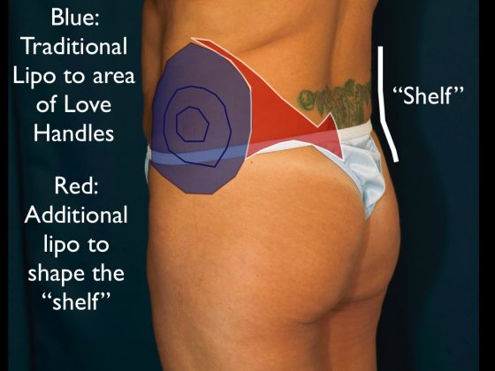 An illustration showing better lipo to love handles techniques.