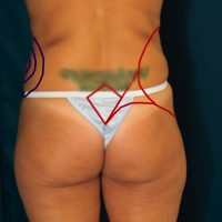 A photo of a patient's lower body, showing the areas (love handles) the liposuction procedure will improve.