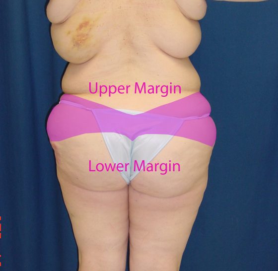 A photo of a patient (back-side) illustrating the skin excision pattern.
