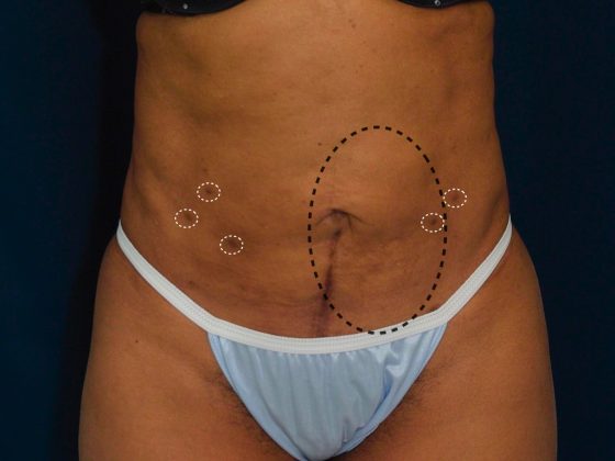 A photo illustrating the poor results of this patient's smart lipo.