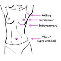 An illustration showing incision types for breast augmentation: inframammary, infraareolar, tuba.