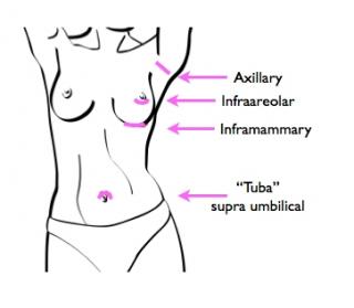 An illustration showing incision types for breast augmentation: inframammary, infraareolar, tuba.
