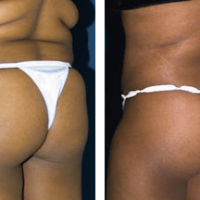 A collage of photos, show a patient's lower body before and after a Brazilian butt lift.