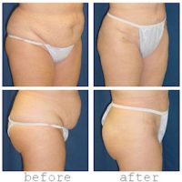 A collage of photos from different angles of a patient before and after a Tummy tuck procedure.