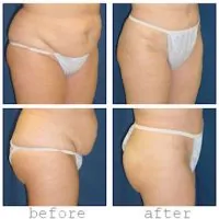 A collage of photos from different angles of a patient before and after a Tummy tuck procedure.