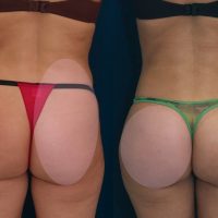 A collage of photos of a patient before & after a Brazilian butt lift procedure.
