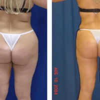 A collage of photos of a patient before and after a Liposuction.