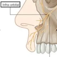 An illustration showing the nerves around the upper lip.