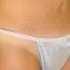 Tummy Tuck scar is placed in panty line