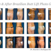 before and after brazilian butt lift pictures