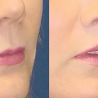 A collage of photos of a patient before & after a Upper lip lift procedure.