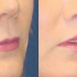 A collage of photos of a patient before & after a Upper lip lift procedure.