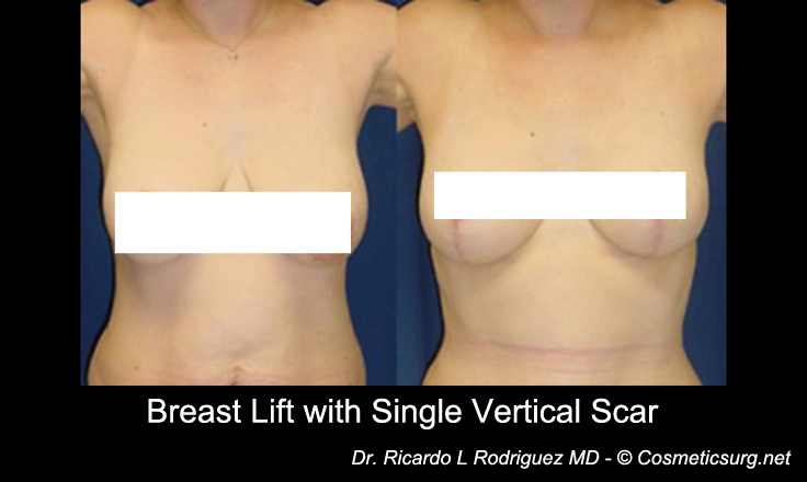 Breast lift scar options - Cosmeticsurg