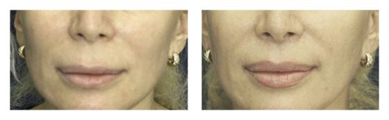A collage of photos of a patient before and after a lip lift procedure.