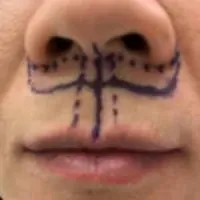 Pre-op lip lift markings on a patient's face.