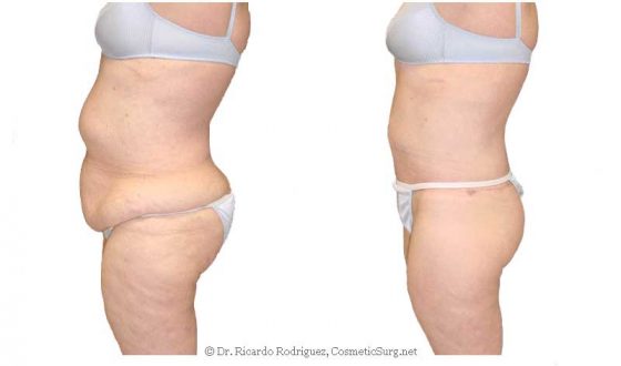 A collage of photos of a patient before & after a body lift procedure.