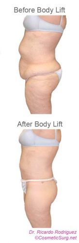 Before & after body lift profile photo.