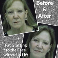 video thumbnail featuring before and after fat grafting to the face with a lip lift along with the patient's before and after headshots