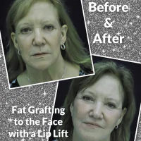 video thumbnail featuring before and after fat grafting to the face with a lip lift along with the patient's before and after headshots