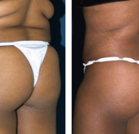 A collage of photos of a patient's lower body, showing her before and after a Brazilian butt lift procedure.