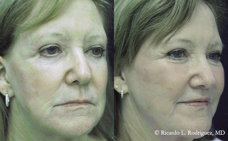 Before and after photos of a patient who had fat grafting to the upper and lower face, liposuction of the jowls, and a lip lift (angle view).