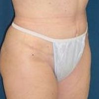 A photo of a patient's lower body, showing an abdominoplasty scar.