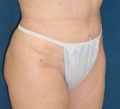 A photo of a patient's lower body, showing an abdominoplasty scar.