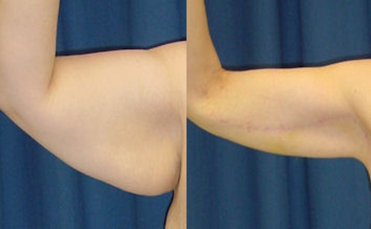 Before and after photo of an actual Arm Lift patient.