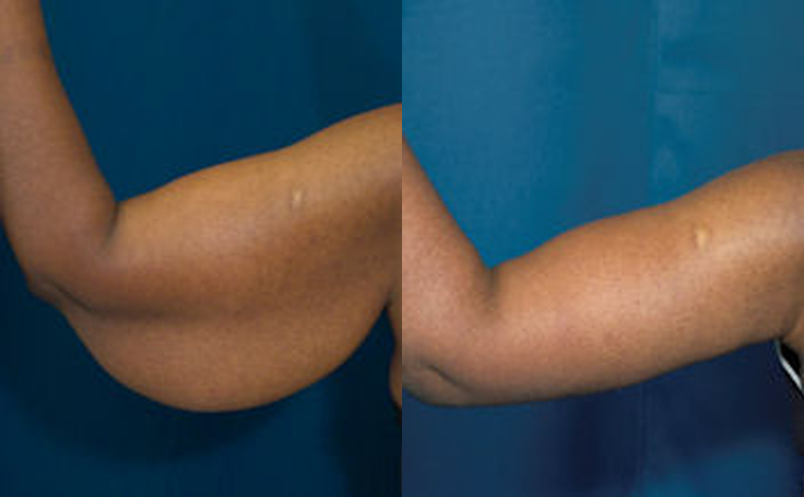 Before and after photo of an actual Arm Lift patient.