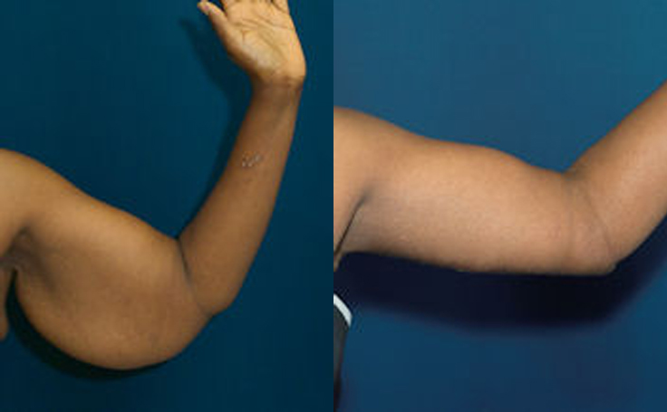 Before and after photo of an actual Arm Lift patient.