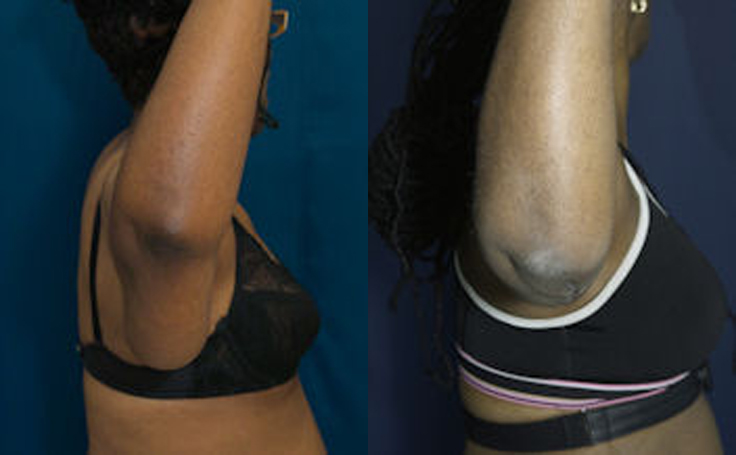 Before and after photo of an actual Arm Lift patient.