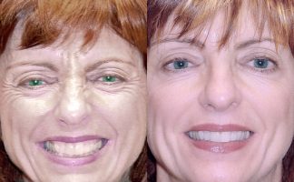 Before and after photo of an actual Botox Injections patient.