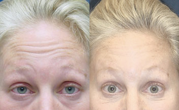 Botox Before & After Photos, Patient Photo, Pictures