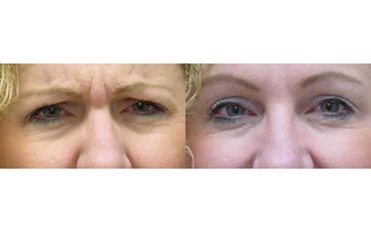 Before and after photo of an actual Botox Injections patient.
